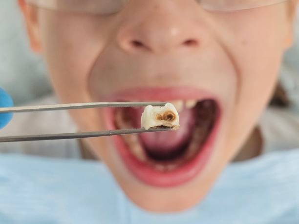Best Knocked-Out Tooth (Avulsed Tooth) Treatment in Elkins Rk, PA